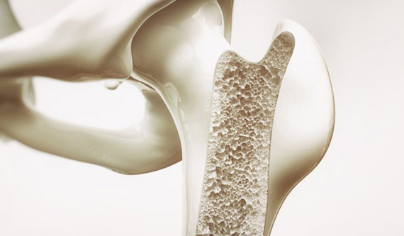 Osteoporoza - „cichy złodziej” kości. Jak ją rozpoznać i przeciwdziałać? Kto jest na nią narażony?